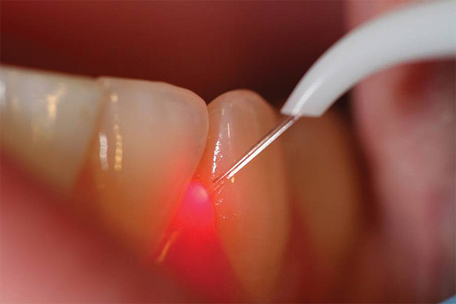 stress free laser gum therapy at downtown dental/nashville