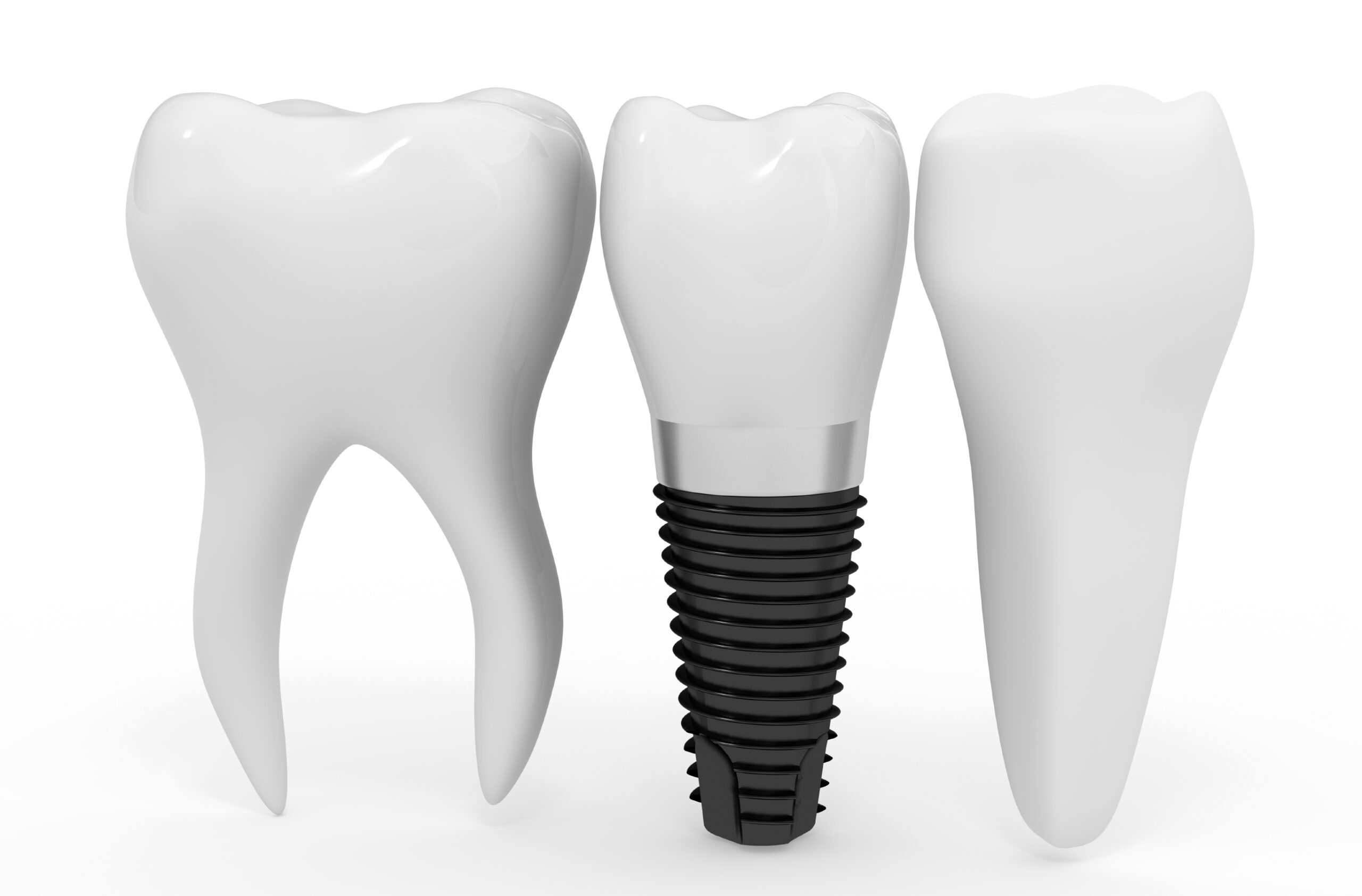implant dentistry at downtown dental nashville: frequently asked questions