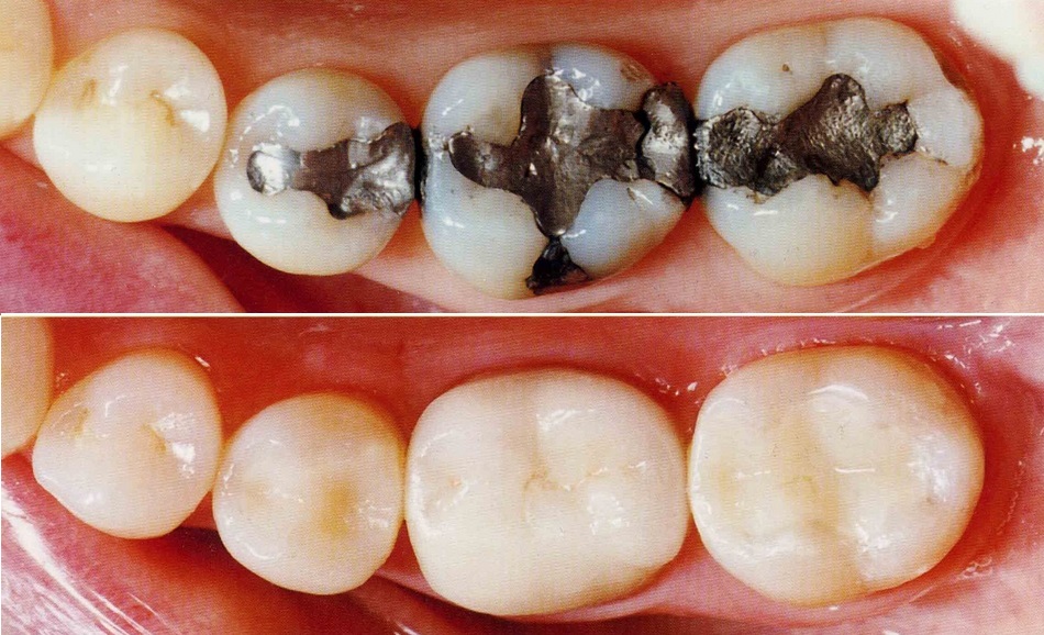 tooth colored fillings