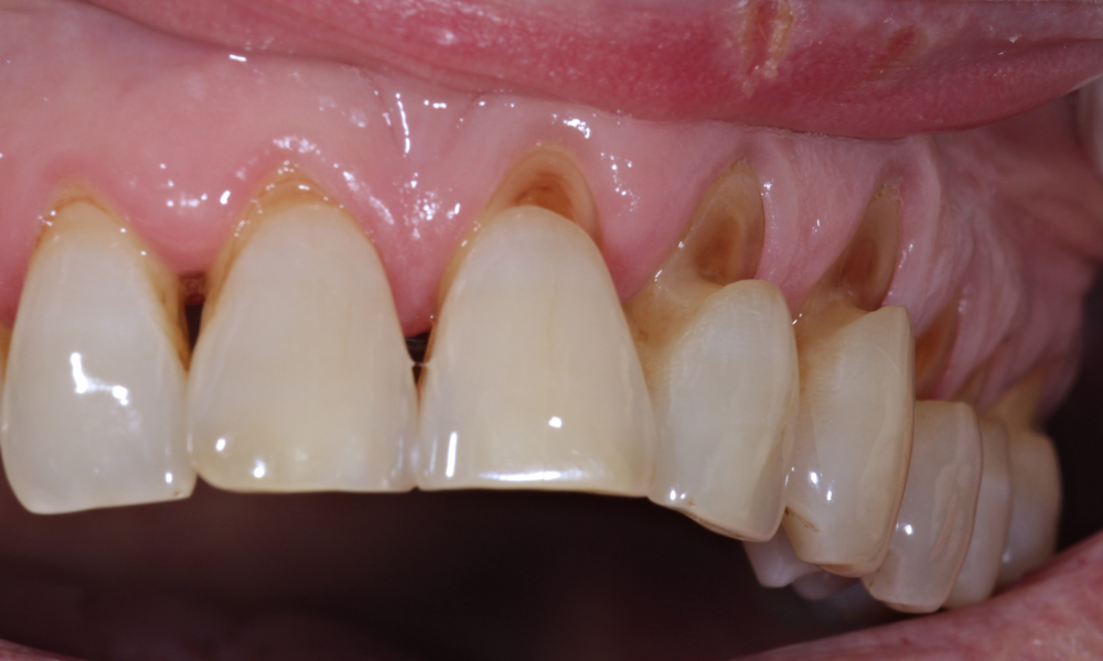 close up of exposed tooth roots and gum recession on front teeth Nashville TN