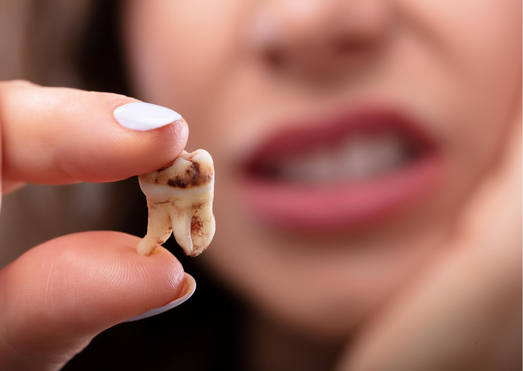 Close-up of a severely decayed tooth with dark brown and black spots, showing what tooth decay can look like when cavities progress and damage the tooth structure.