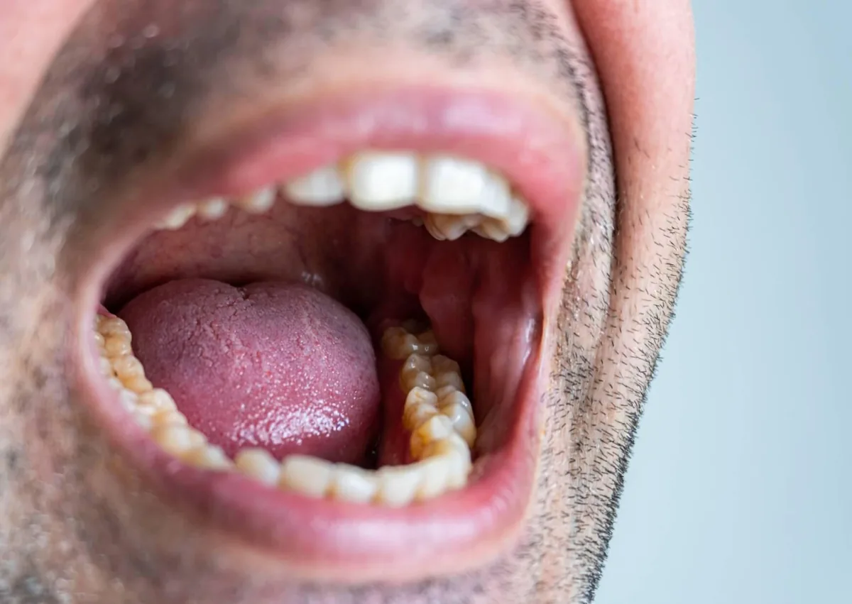 Close-up of an open mouth showing teeth and oral tissues that can be affected by dry mouth.